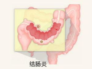 治疗结肠炎好的医院是哪家